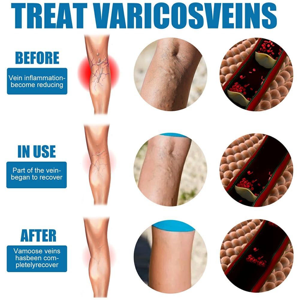 South Moon Varicose Veins Treatment Spray