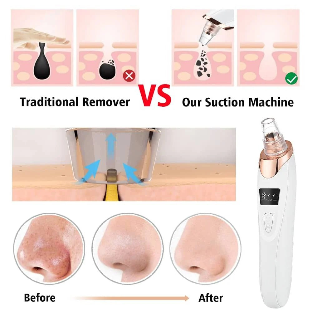 Digital Blackhead Remover Vacuum